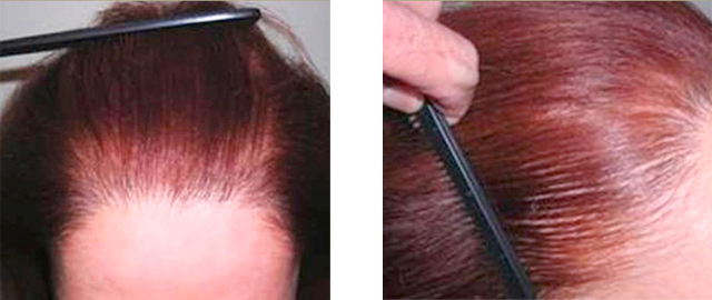 Successful Female Hair Restoration
