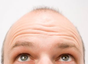 Hairlines and Heart Health- Is Hair Loss a Sign of Heart Disease?