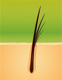 Read more about the article Hair Miniaturization: What Causes It?