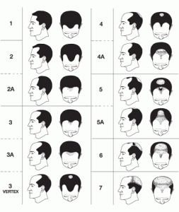 Norwood Classification for Male Hair Loss