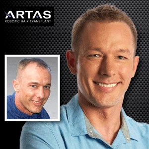 ARTAS-Transplant-Before-and-After-Photos