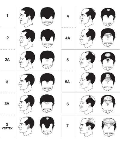 Norwood-Classification-for-baldness-in-men