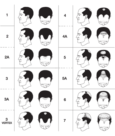 Norwood Chart Pattern Baldness