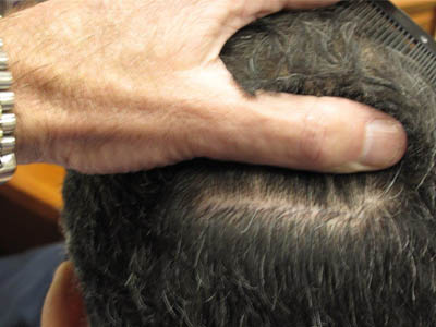 Do Hair Transplants Leave Scars? 
