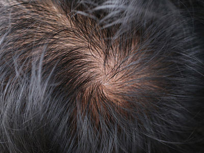 4 Easy Ways to Stop Male Hair Loss 
