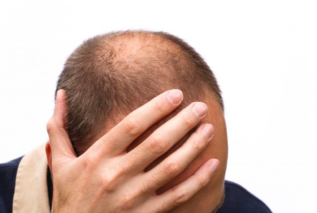 psychological impact of hair loss