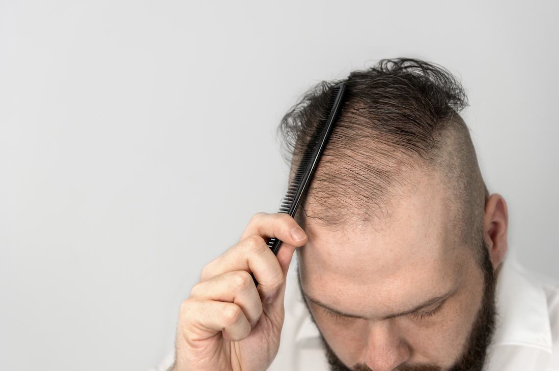Does Finasteride Help Hair Growth  Quartz Hair