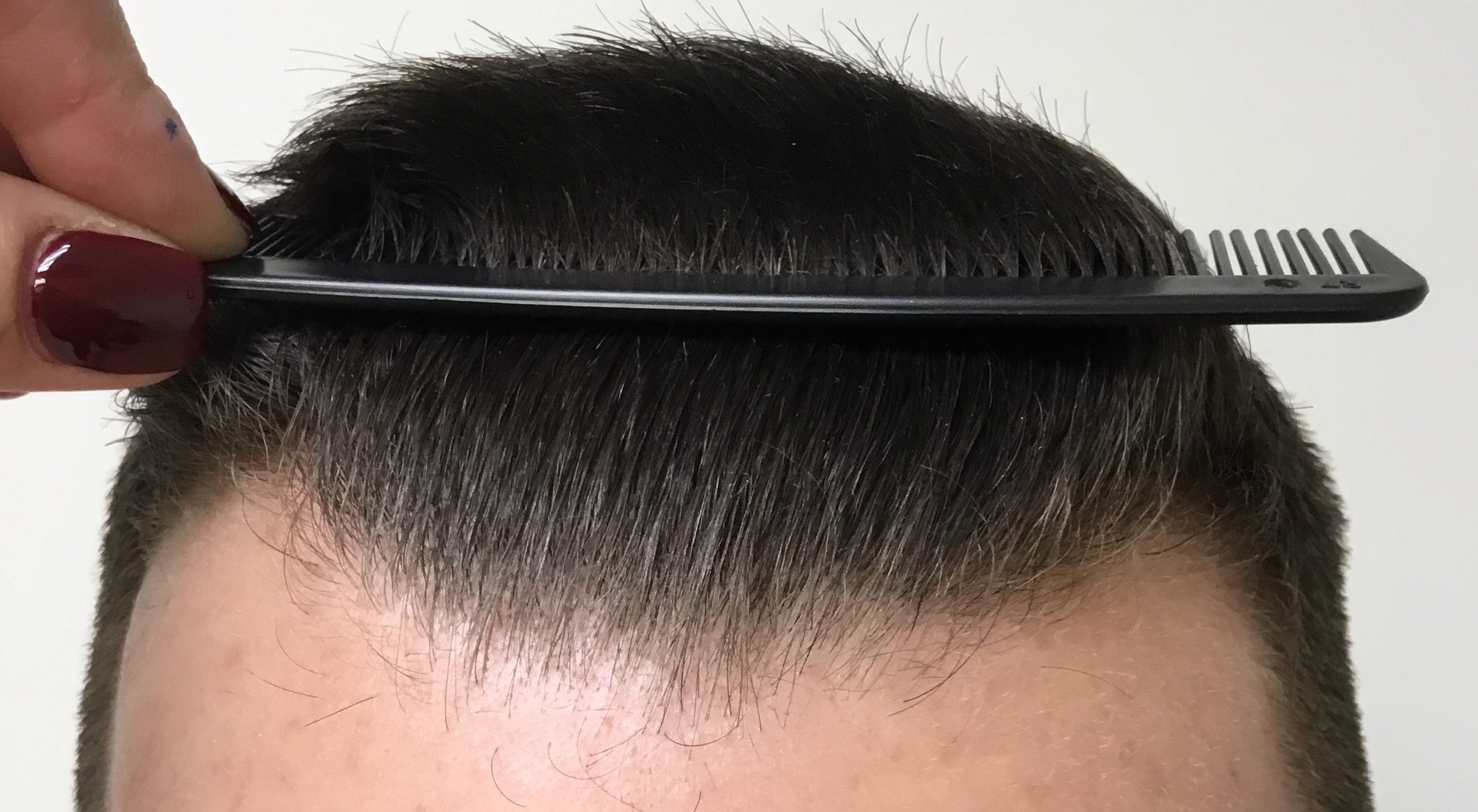 Read more about the article Game-Changing MOSAIC® Hair Restoration at Miami Hair Institute