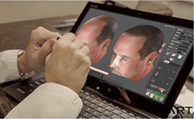 Read more about the article ARTAS® Robotic Hair Transplant Before & After